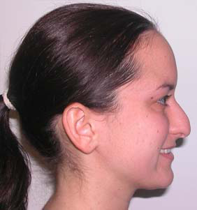 Nose Surgery (Rhinoplasty)