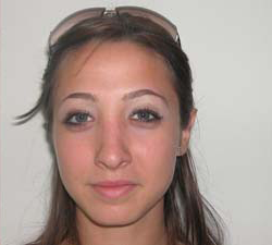 Nose Surgery (Rhinoplasty) After Photo Nose Surgery (Rhinoplasty)