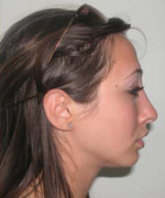 Nose Surgery (Rhinoplasty)