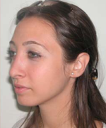 Nose Surgery (Rhinoplasty)