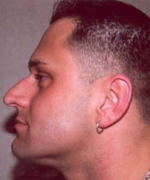 Nose Surgery (Rhinoplasty)