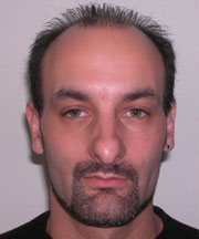 Nose Surgery (Rhinoplasty) Before Photo Nose Surgery (Rhinoplasty)