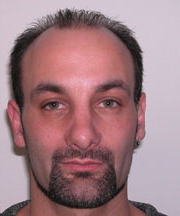 Nose Surgery (Rhinoplasty) After Photo Nose Surgery (Rhinoplasty)