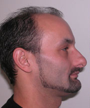 Nose Surgery (Rhinoplasty)