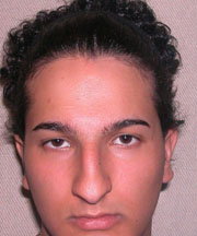 Nose Surgery (Rhinoplasty) Before Photo Nose Surgery (Rhinoplasty)