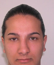 Nose Surgery (Rhinoplasty) After Photo Nose Surgery (Rhinoplasty)