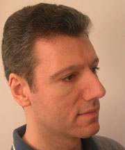 Nose Surgery (Rhinoplasty)