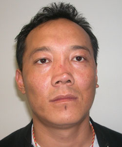 Nose Surgery (Rhinoplasty) Before Photo Nose Surgery (Rhinoplasty)