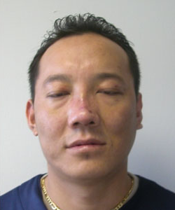 Nose Surgery (Rhinoplasty) After Photo Nose Surgery (Rhinoplasty)