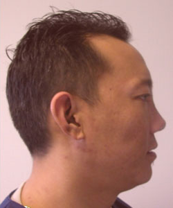 Nose Surgery (Rhinoplasty)