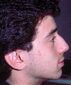 Nose Surgery (Rhinoplasty)