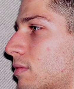 Nose Surgery (Rhinoplasty)