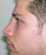 Nose Surgery (Rhinoplasty)