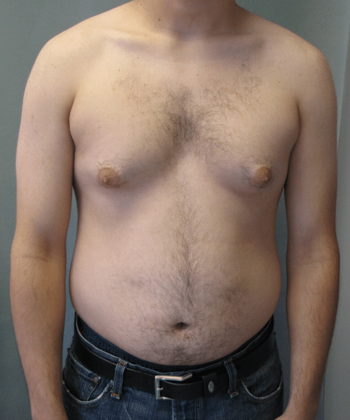 Puffy Nipples Before Photo Puffy Nipples
