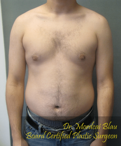 Puffy Nipples After Photo Puffy Nipples