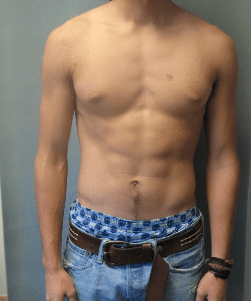 Puffy Nipples Before Photo Puffy Nipples
