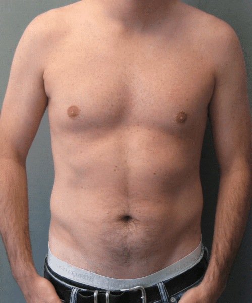 Puffy Nipples Before Photo Puffy Nipples