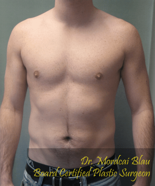 Puffy Nipples After Photo Puffy Nipples