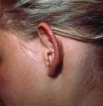 Otoplasty (Ear Surgery)