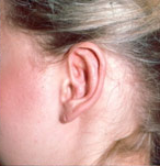 Otoplasty (Ear Surgery)