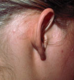 Otoplasty (Ear Surgery)