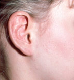 Otoplasty (Ear Surgery)