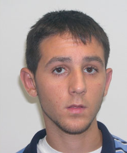 Otoplasty (Ear Surgery) After Photo Otoplasty (Ear Surgery)