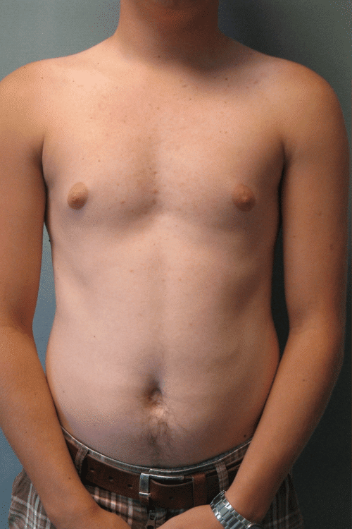 Puffy Nipples Before Photo Puffy Nipples