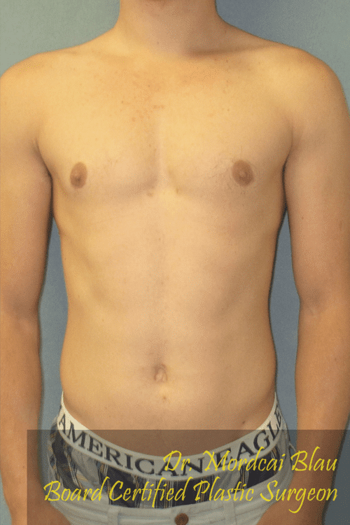 Puffy Nipples After Photo Puffy Nipples