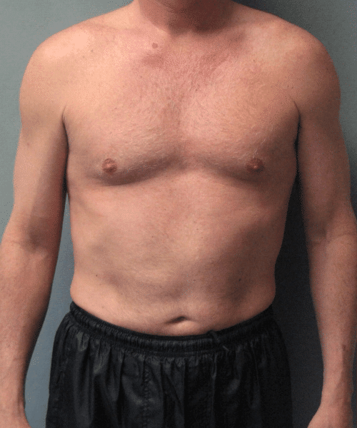 Puffy Nipples Before Photo Puffy Nipples