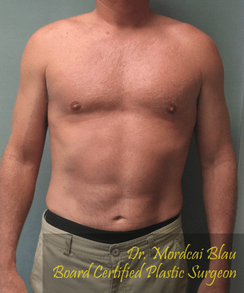 Puffy Nipples After Photo Puffy Nipples