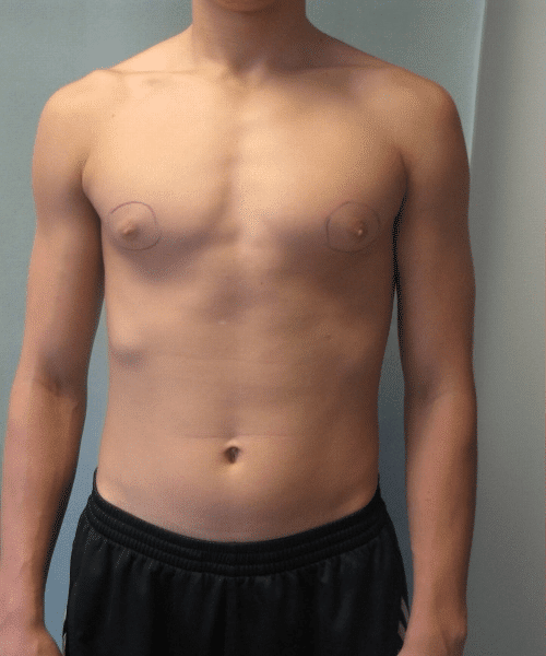 Puffy Nipples Before Photo Puffy Nipples