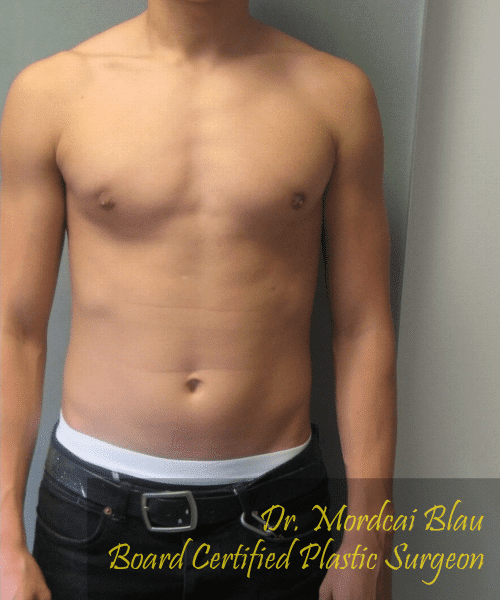 Puffy Nipples After Photo Puffy Nipples