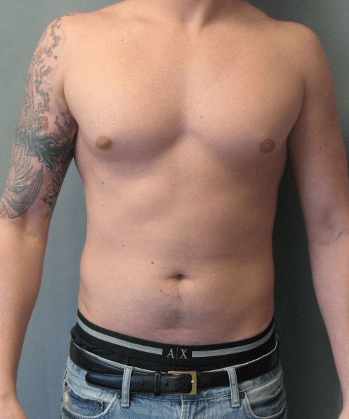 Puffy Nipples Before Photo Puffy Nipples