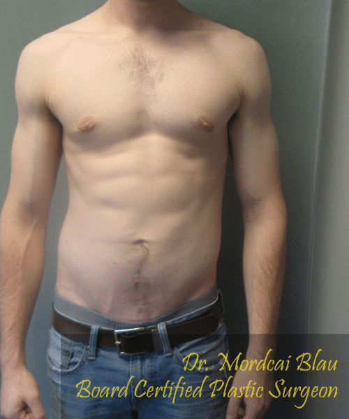Puffy Nipples After Photo Puffy Nipples