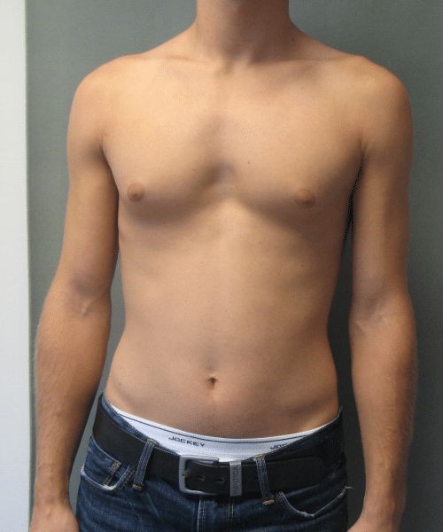 Puffy Nipples Before Photo Puffy Nipples