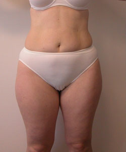 Abs, Waist and Thighs Before Photo Abs, Waist and Thighs