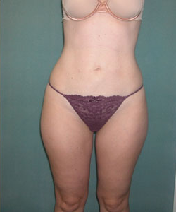 Abs, Waist and Thighs After Photo Abs, Waist and Thighs