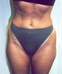 Abs, Waist and Thighs Before Photo Abs, Waist and Thighs