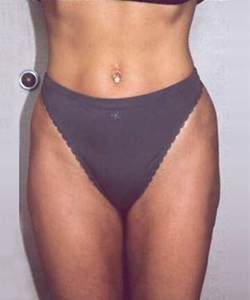 Abs, Waist and Thighs After Photo Abs, Waist and Thighs
