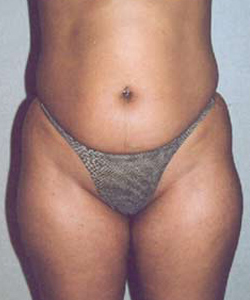 Abs, Waist and Thighs Before Photo Abs, Waist and Thighs
