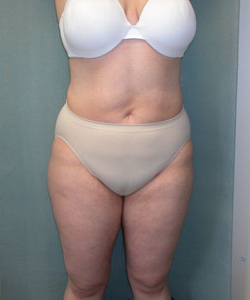 Abs, Waist and Thighs After Photo Abs, Waist and Thighs