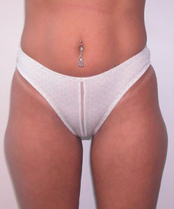Abs, Waist and Thighs Before Photo Abs, Waist and Thighs