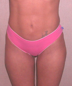 Abs, Waist and Thighs After Photo Abs, Waist and Thighs