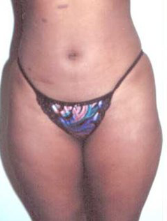 Abs, Waist and Thighs Before Photo Abs, Waist and Thighs