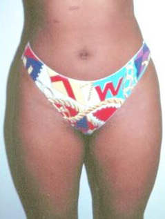 Abs, Waist and Thighs After Photo Abs, Waist and Thighs
