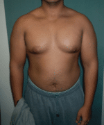 Pseudogynecomastia