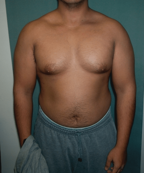 Pseudogynecomastia Before Photo Pseudogynecomastia
