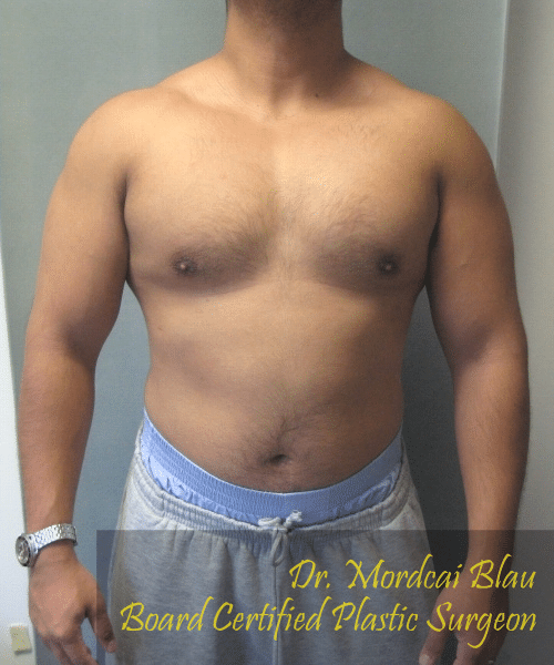 Pseudogynecomastia After Photo Pseudogynecomastia