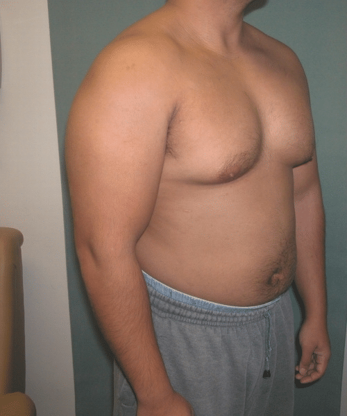 Pseudogynecomastia